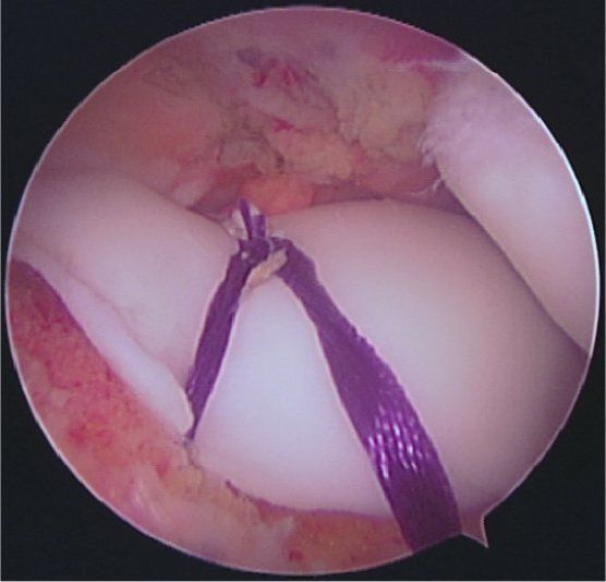 Arthroscopic trochleoplasty Amolly