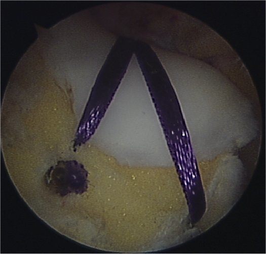 Arthroscopic trochleoplasty S Johansen b