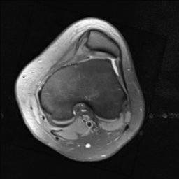 Trochlear Dysplasia it´s relation to loose kneecap and AKP