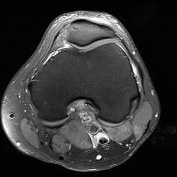 Normal Mri Knee